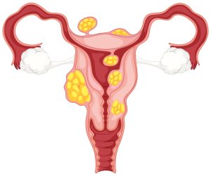 PCOS name change