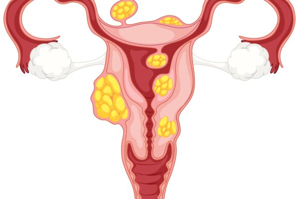 PCOS name change