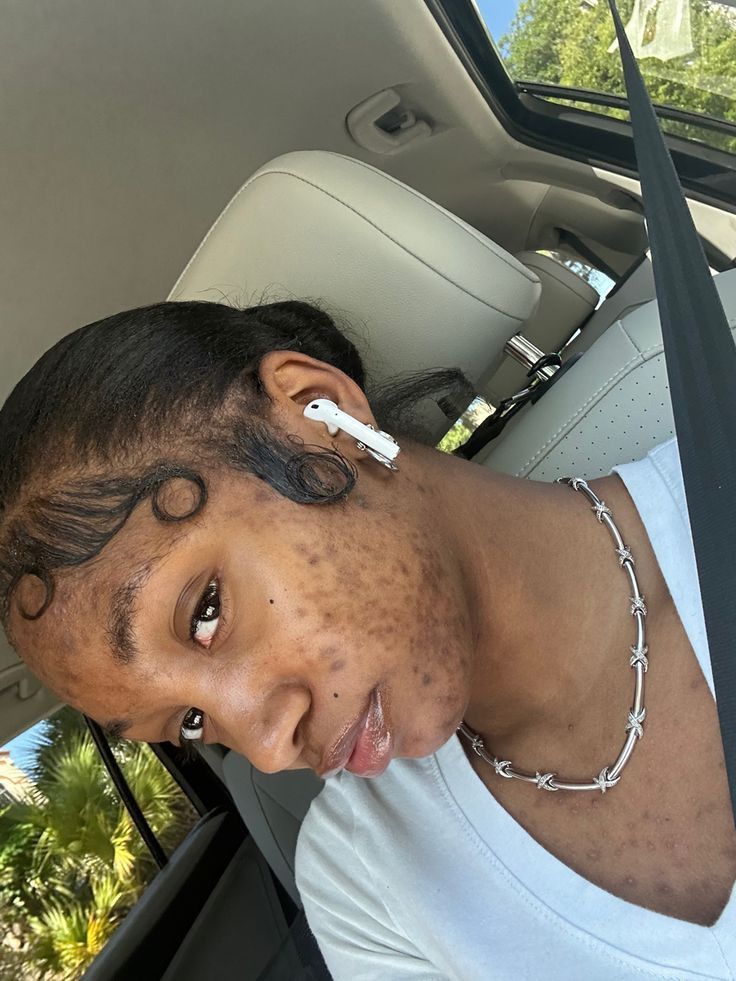 bad acne