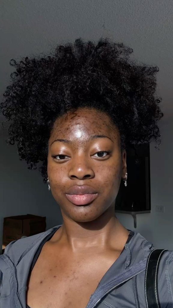 bad acne