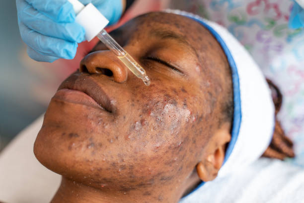 bad acne