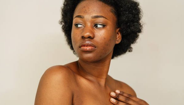 bad acne